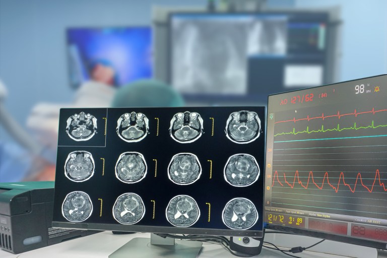 CT Scan brain Finding isodense mass with ill-defined margin and surrounding edema at the Left frontal lobe. Glioblastoma, brain metastasis. Blurry operating room background.